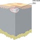 Haut Effloreszenzen Quaddel 3D Block
