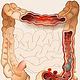 Pathologie des Dickdarms