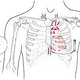 Position subkutaner Herzschrittmacher